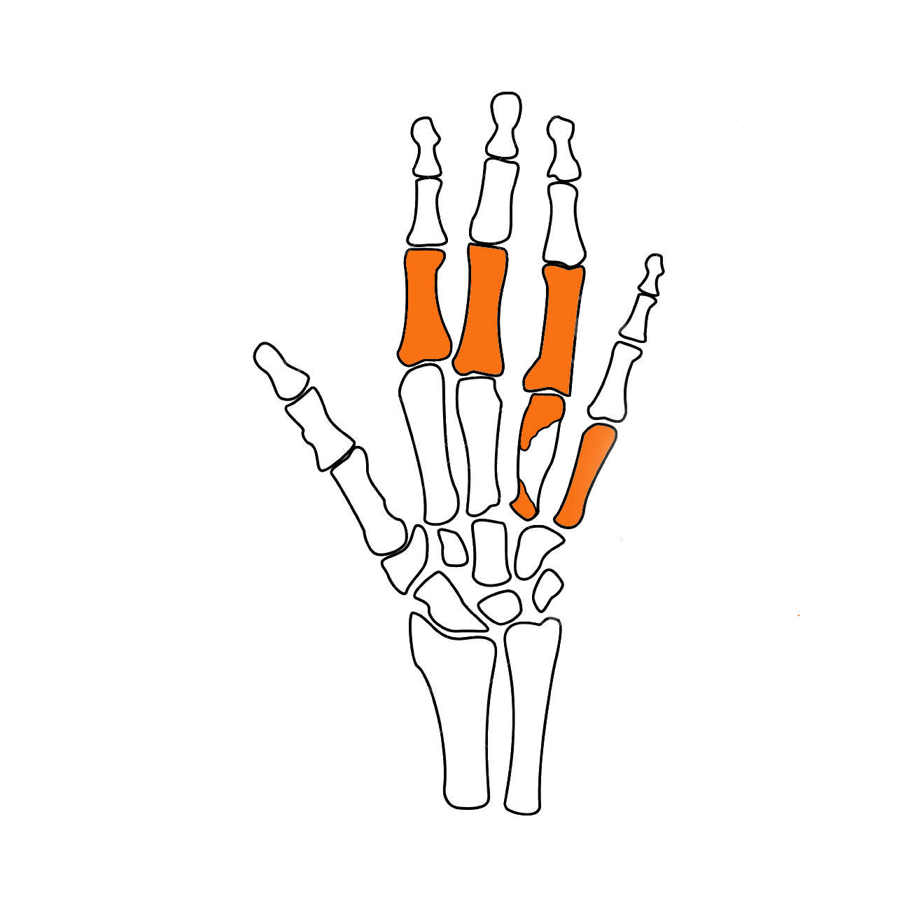 Schematische Zeichnung einer rechten Hand mit farblicher Hervorhebung der aufgefundenen Knochen.
